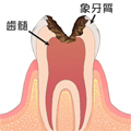 C3 - むし歯の後期状態（中期）