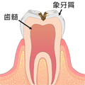 C2 - むし歯の後期状態（初期）