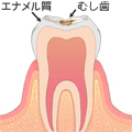 C1 - むし歯の中期状態