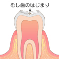 C0 - むし歯の初期状態