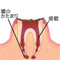 C4 - むし歯の末期状態